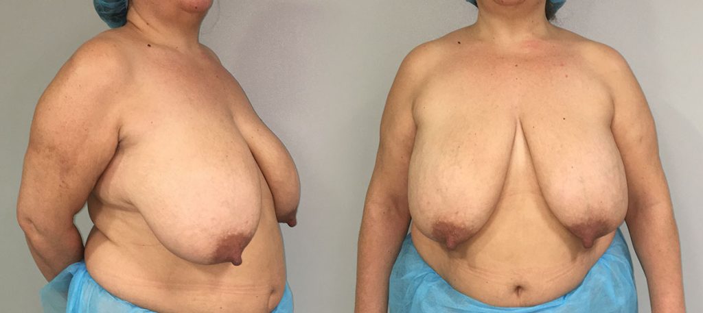 caso-08-mama-con-gran-ptosis-y-asimetria