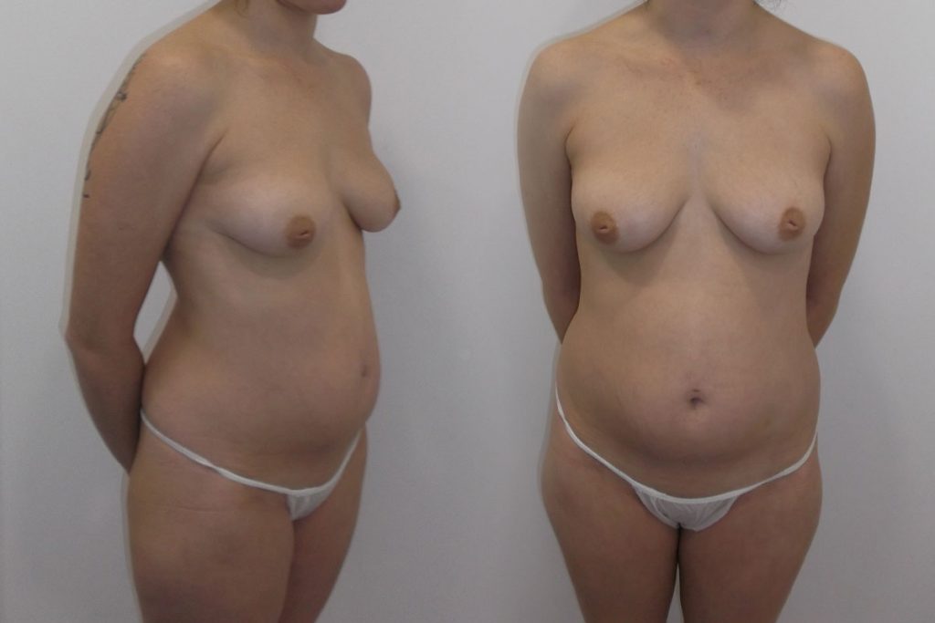 caso-10-liposuccion-mastopexia-lipofilling