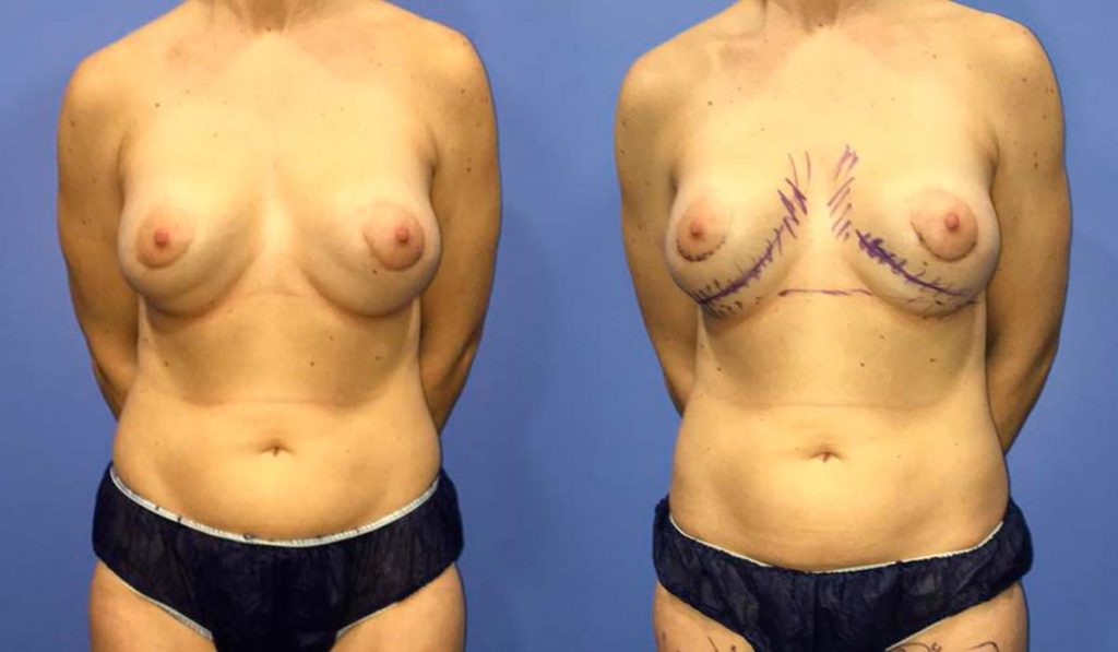caso-12-lipofilling-mamario-doble-burbuja