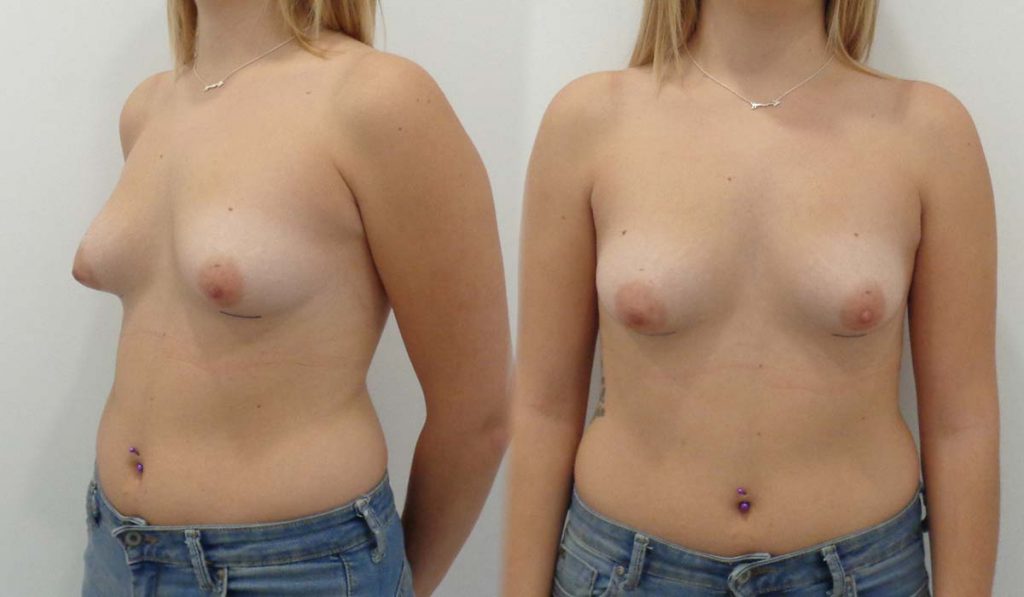 caso-13-mastopexia-periareolar-aumento-submuscular