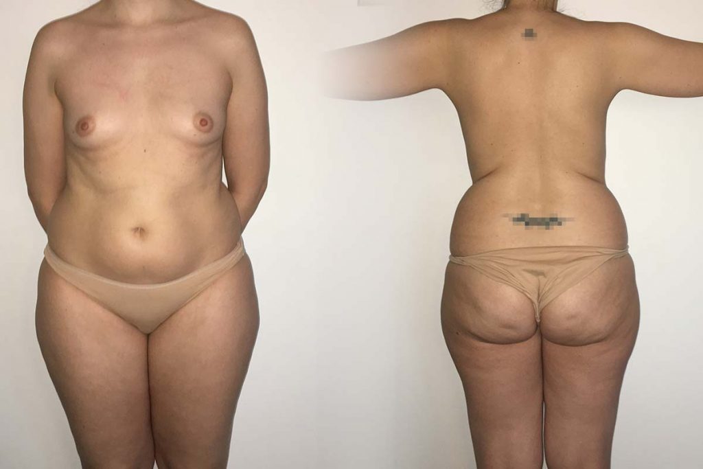 caso-14-lipoescultura-con-lipofiling-de-mamas