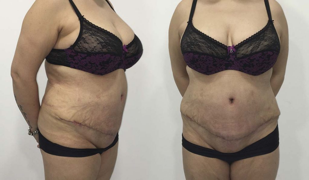 caso-15-abdominoplastia-post