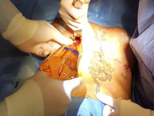 doctor-carlos-navarro-minimal-scar-3